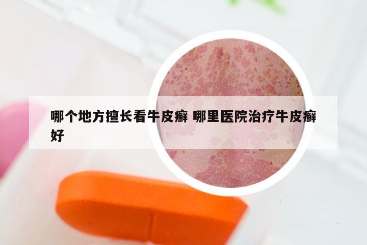 哪个地方擅长看牛皮癣 哪里医院治疗牛皮癣好
