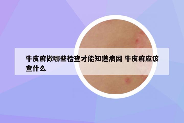 牛皮癣做哪些检查才能知道病因 牛皮癣应该查什么