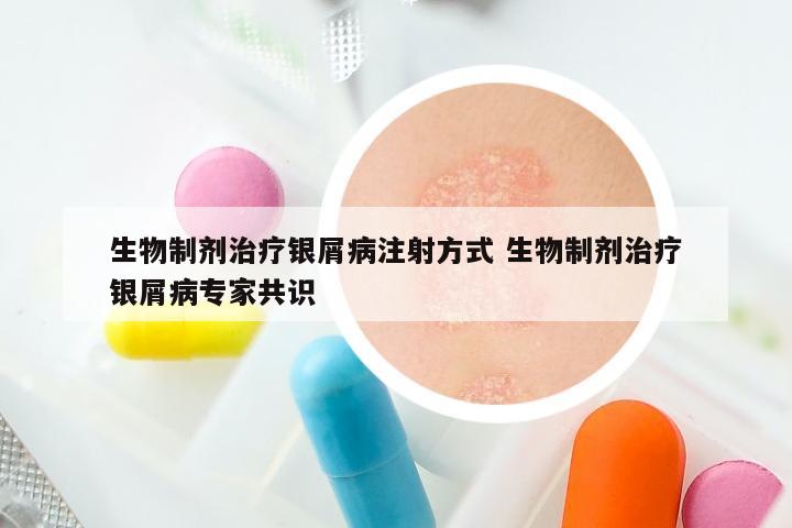 生物制剂治疗银屑病注射方式 生物制剂治疗银屑病专家共识