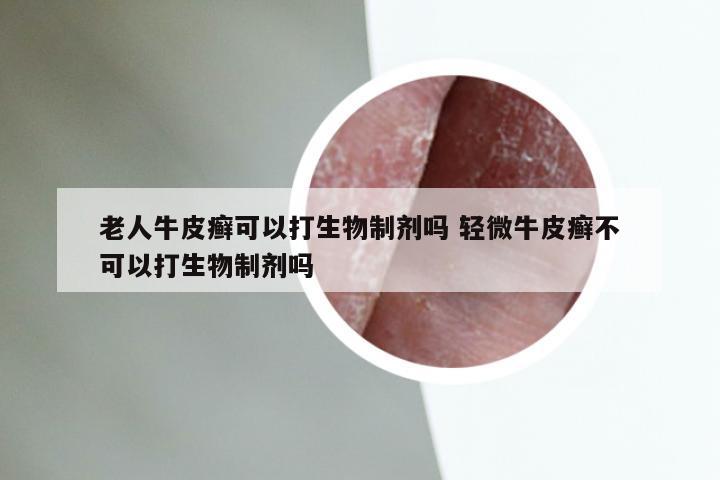 老人牛皮癣可以打生物制剂吗 轻微牛皮癣不可以打生物制剂吗
