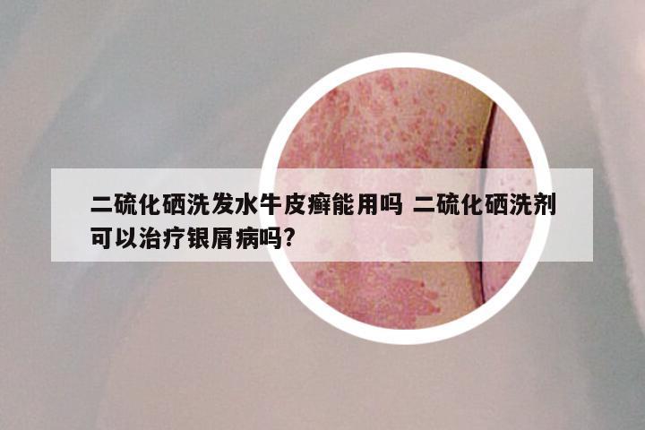 二硫化硒洗发水牛皮癣能用吗 二硫化硒洗剂可以治疗银屑病吗?