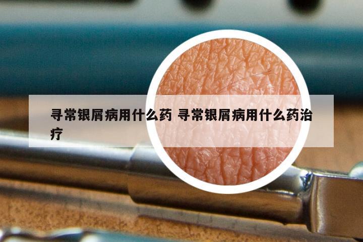 寻常银屑病用什么药 寻常银屑病用什么药治疗