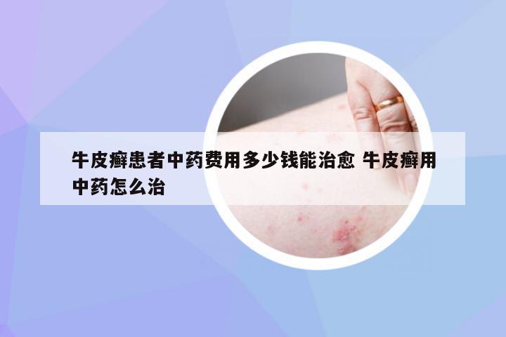 牛皮癣患者中药费用多少钱能治愈 牛皮癣用中药怎么治
