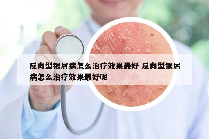 反向型银屑病怎么治疗效果最好 反向型银屑病怎么治疗效果最好呢