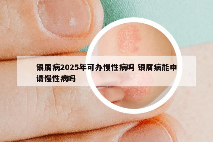 银屑病2025年可办慢性病吗 银屑病能申请慢性病吗