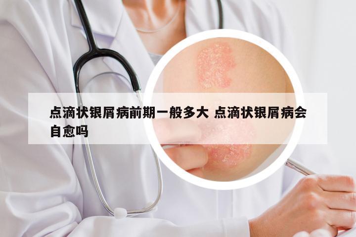 点滴状银屑病前期一般多大 点滴状银屑病会自愈吗