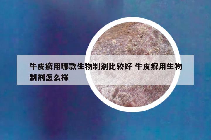 牛皮癣用哪款生物制剂比较好 牛皮癣用生物制剂怎么样
