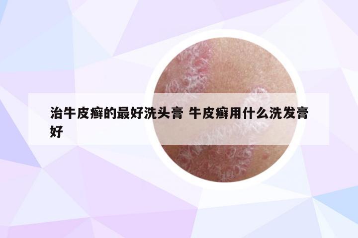 治牛皮癣的最好洗头膏 牛皮癣用什么洗发膏好