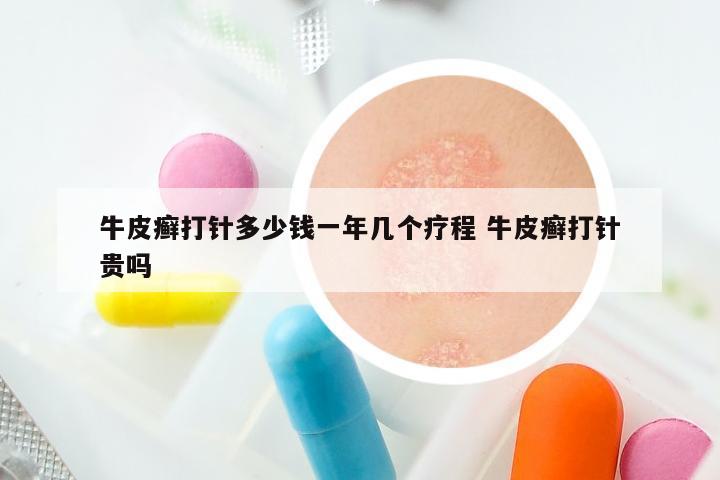 牛皮癣打针多少钱一年几个疗程 牛皮癣打针贵吗