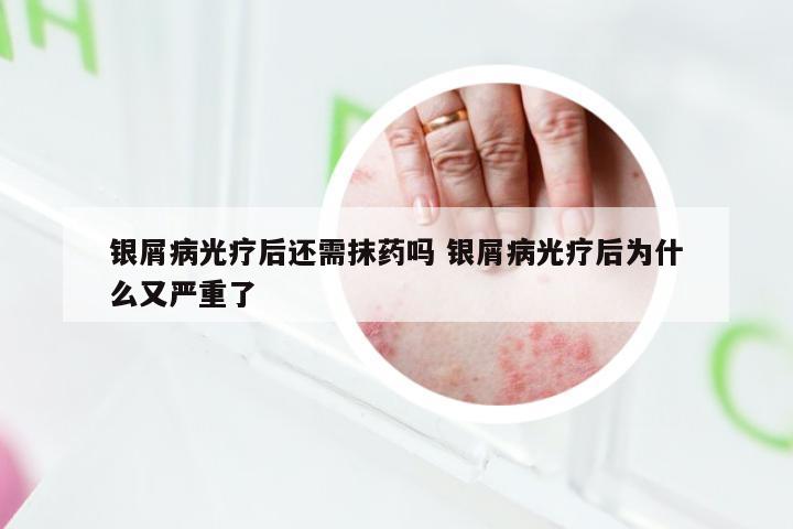 银屑病光疗后还需抹药吗 银屑病光疗后为什么又严重了