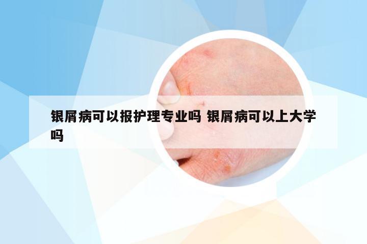 银屑病可以报护理专业吗 银屑病可以上大学吗
