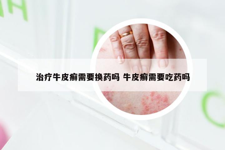 治疗牛皮癣需要换药吗 牛皮癣需要吃药吗