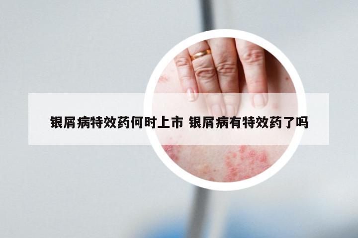 银屑病特效药何时上市 银屑病有特效药了吗