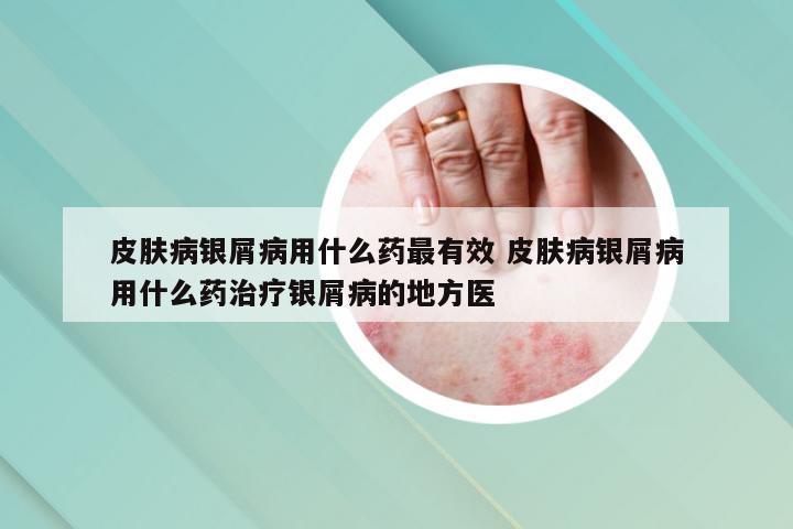 皮肤病银屑病用什么药最有效 皮肤病银屑病用什么药治疗银屑病的地方医