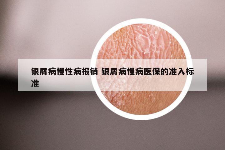 银屑病慢性病报销 银屑病慢病医保的准入标准