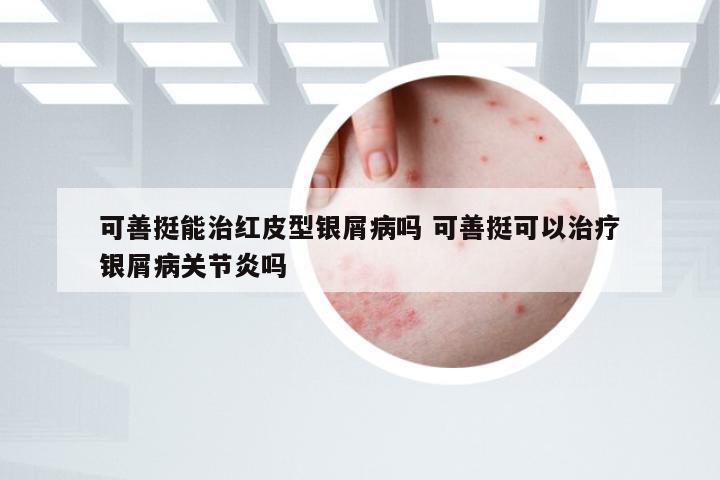 可善挺能治红皮型银屑病吗 可善挺可以治疗银屑病关节炎吗