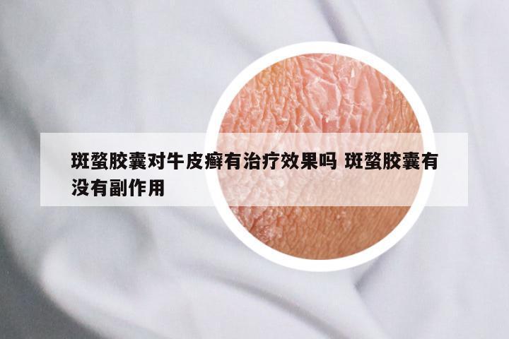 斑蝥胶囊对牛皮癣有治疗效果吗 斑蝥胶囊有没有副作用