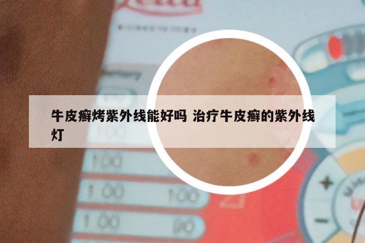 牛皮癣烤紫外线能好吗 治疗牛皮癣的紫外线灯