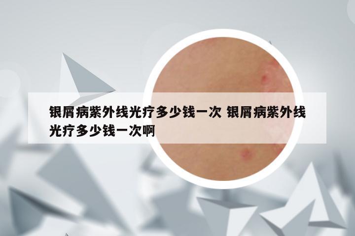 银屑病紫外线光疗多少钱一次 银屑病紫外线光疗多少钱一次啊