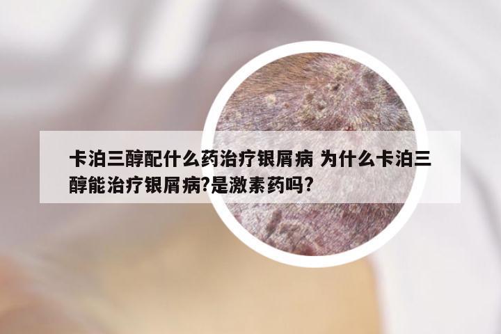 卡泊三醇配什么药治疗银屑病 为什么卡泊三醇能治疗银屑病?是激素药吗?
