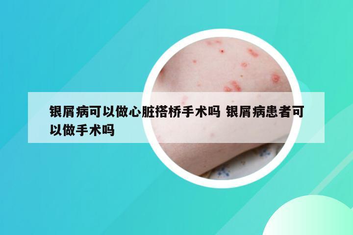 银屑病可以做心脏搭桥手术吗 银屑病患者可以做手术吗