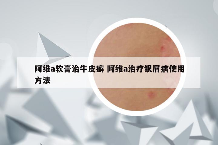 阿维a软膏治牛皮癣 阿维a治疗银屑病使用方法