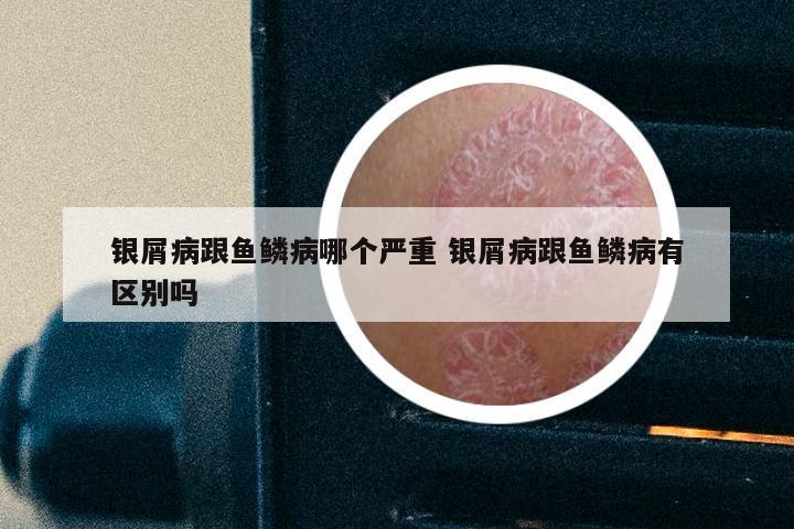 银屑病跟鱼鳞病哪个严重 银屑病跟鱼鳞病有区别吗
