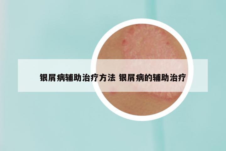 银屑病辅助治疗方法 银屑病的辅助治疗