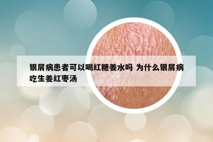 银屑病患者可以喝红糖姜水吗 为什么银屑病吃生姜红枣汤