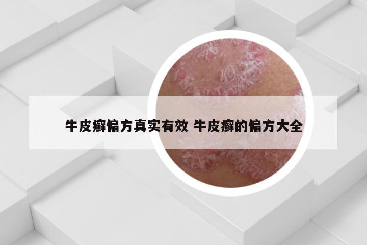 牛皮癣偏方真实有效 牛皮癣的偏方大全