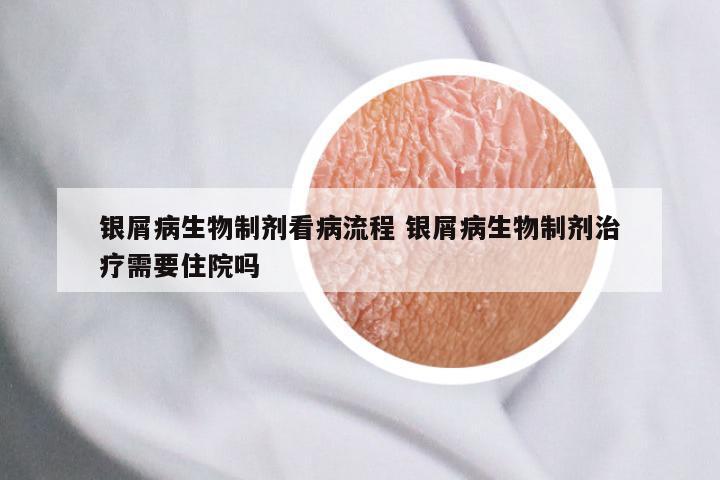 银屑病生物制剂看病流程 银屑病生物制剂治疗需要住院吗