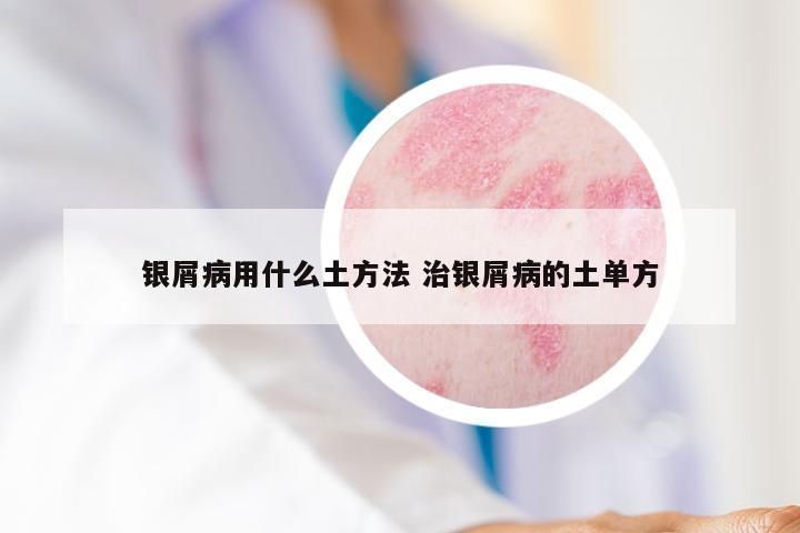 银屑病用什么土方法 治银屑病的土单方