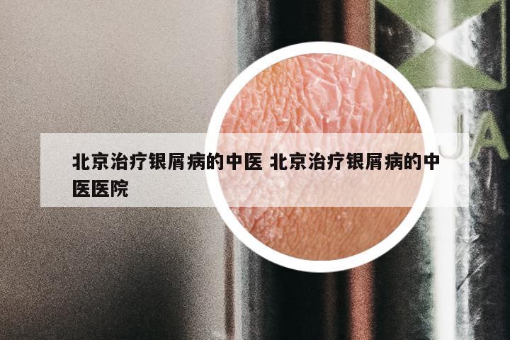 北京治疗银屑病的中医 北京治疗银屑病的中医医院