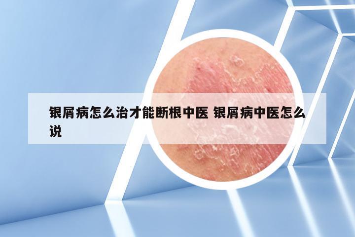银屑病怎么治才能断根中医 银屑病中医怎么说