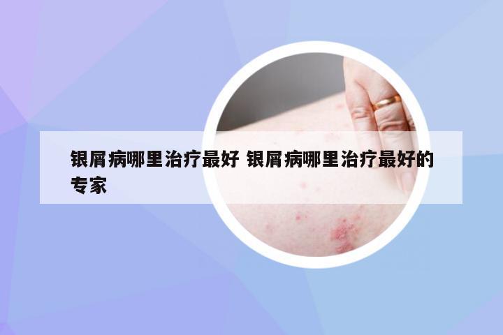 银屑病哪里治疗最好 银屑病哪里治疗最好的专家