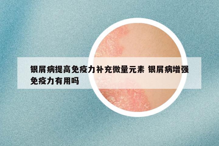 银屑病提高免疫力补充微量元素 银屑病增强免疫力有用吗
