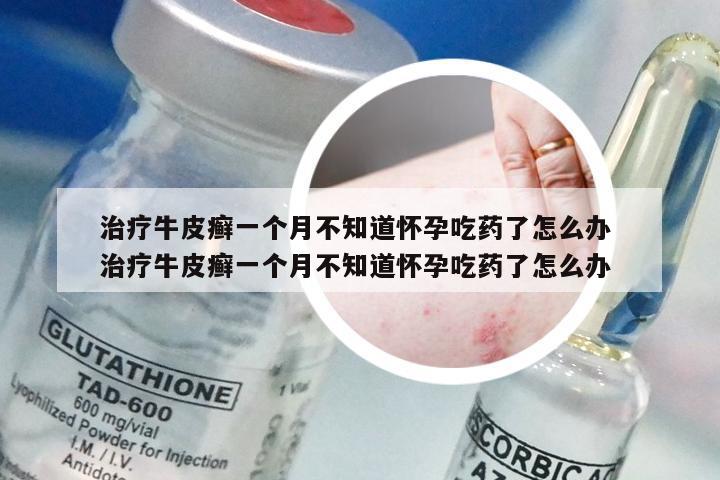 治疗牛皮癣一个月不知道怀孕吃药了怎么办 治疗牛皮癣一个月不知道怀孕吃药了怎么办