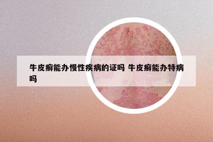 牛皮癣能办慢性疾病的证吗 牛皮癣能办特病吗