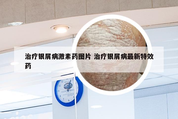 治疗银屑病激素药图片 治疗银屑病最新特效药