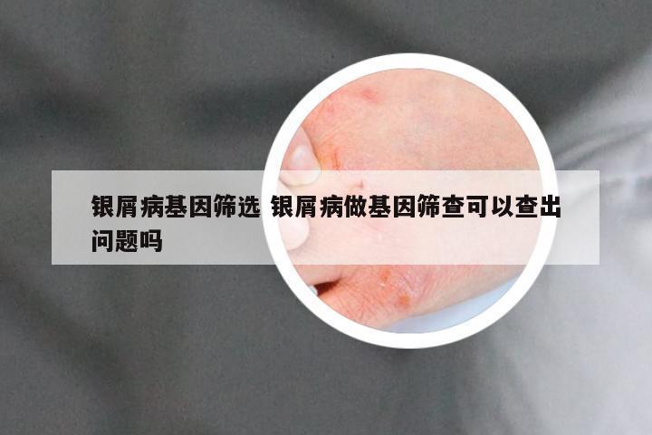 银屑病基因筛选 银屑病做基因筛查可以查出问题吗