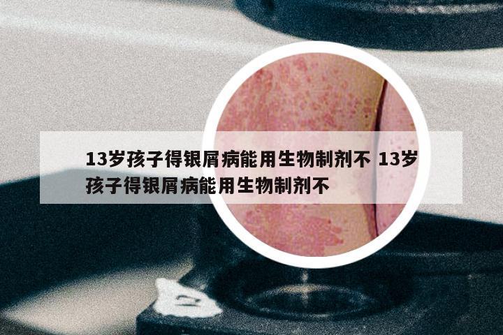 13岁孩子得银屑病能用生物制剂不 13岁孩子得银屑病能用生物制剂不