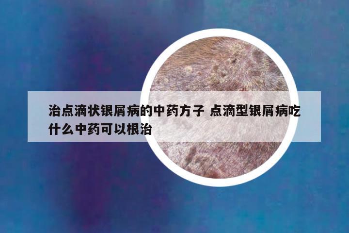 治点滴状银屑病的中药方子 点滴型银屑病吃什么中药可以根治