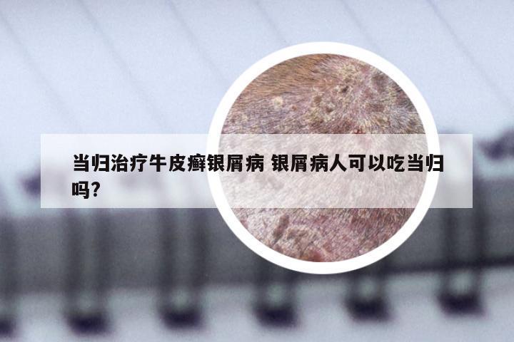 当归治疗牛皮癣银屑病 银屑病人可以吃当归吗?