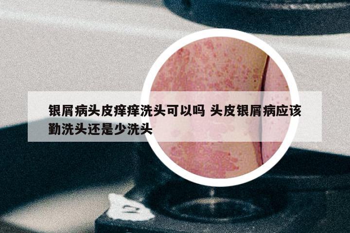 银屑病头皮痒痒洗头可以吗 头皮银屑病应该勤洗头还是少洗头