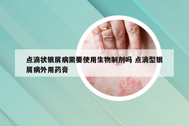点滴状银屑病需要使用生物制剂吗 点滴型银屑病外用药膏
