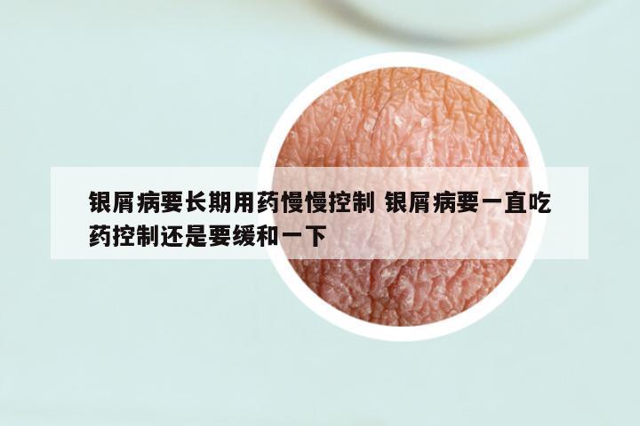 银屑病要长期用药慢慢控制 银屑病要一直吃药控制还是要缓和一下