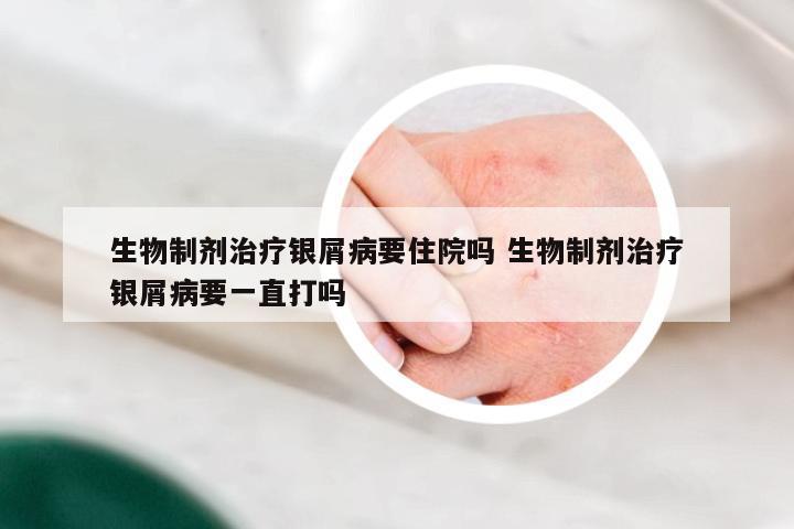 生物制剂治疗银屑病要住院吗 生物制剂治疗银屑病要一直打吗