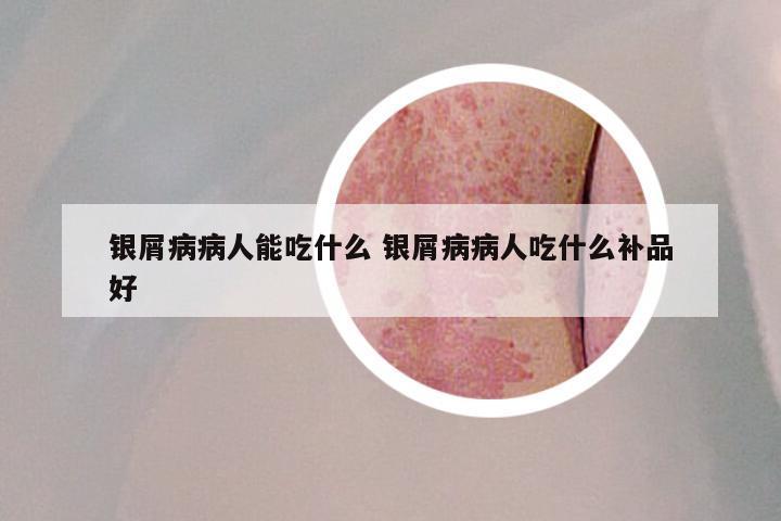 银屑病病人能吃什么 银屑病病人吃什么补品好
