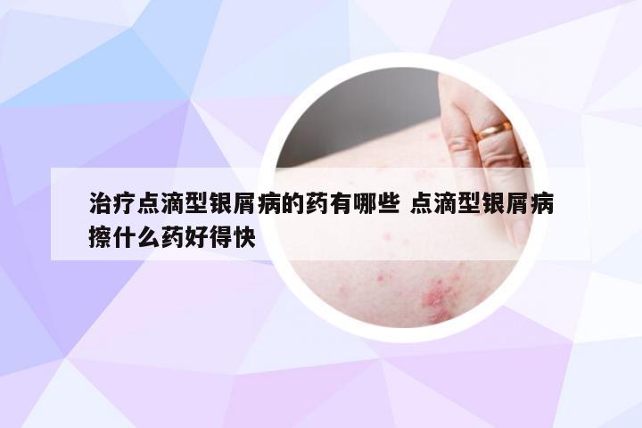 治疗点滴型银屑病的药有哪些 点滴型银屑病擦什么药好得快