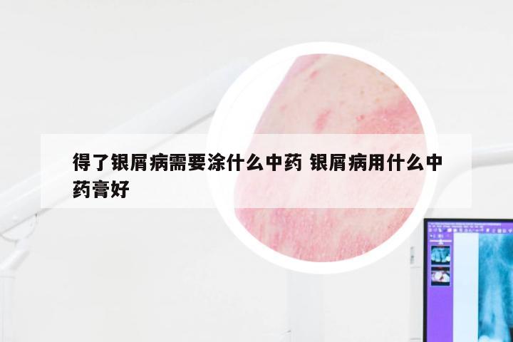 得了银屑病需要涂什么中药 银屑病用什么中药膏好